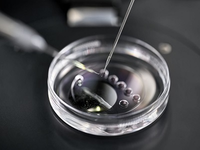 IVF USING DONOR SPERM​